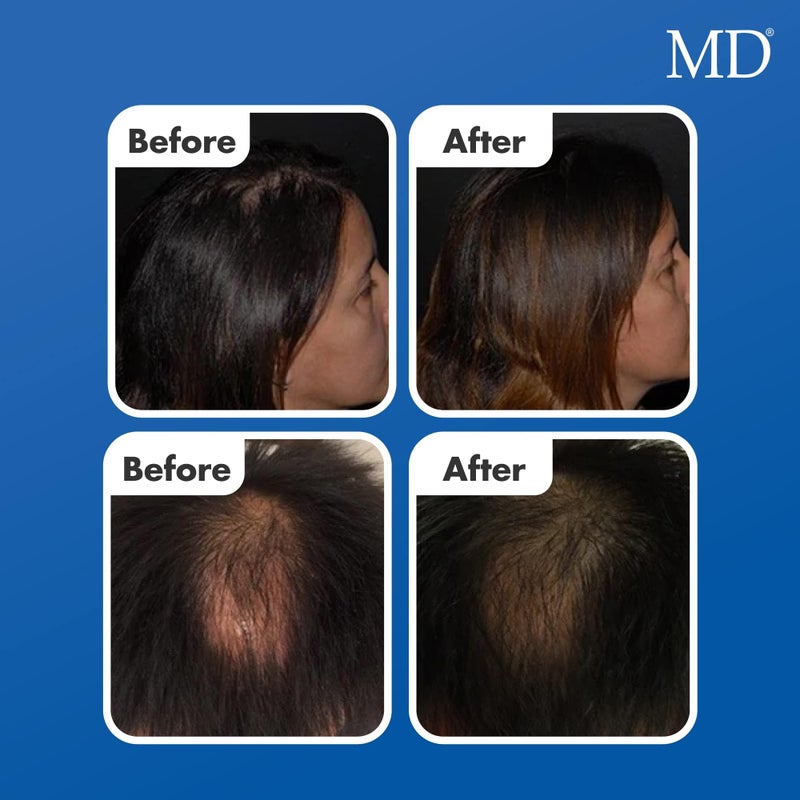 MD suero natural para el crecimiento del cabello | Follicle Energizer Serum: evita el adelgazamiento del cabello y la pÃ©rdida de cabello al estimular los folÃ­culos capilares para producir un ca - Image 5